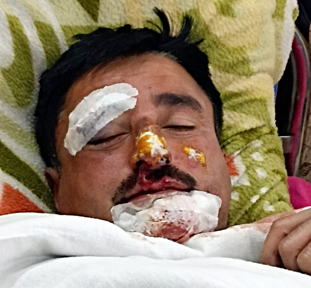 स्मैक तस्करी की सूचना पर पीछा कर रहे पुलिस कर्मी बाइक दुर्घटना में घायल