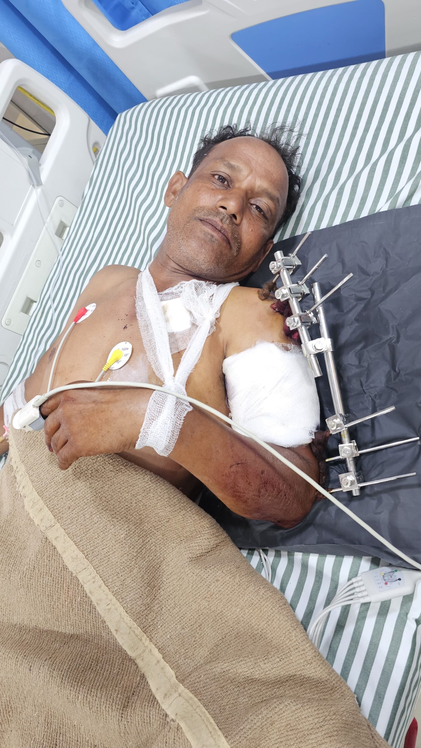 मकान पर घुसे चोर ने पीछा करने पर व्यक्ति पर की फायरिंग, कंधे पर लगी गोली