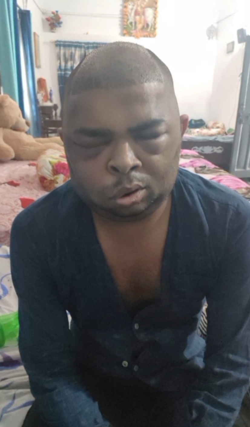 उप्रः कानपुर में हेयर ट्रांसप्लांट के बाद एक और इंजीनियर की मौत, डीसीपी ने दिए जांच के आदेश